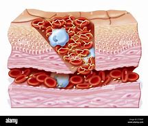 Image result for cicatrization