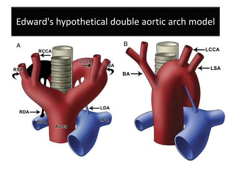 PPT - AORTIC ARCH ANOMALIES PowerPoint Presentation, free download - ID ...