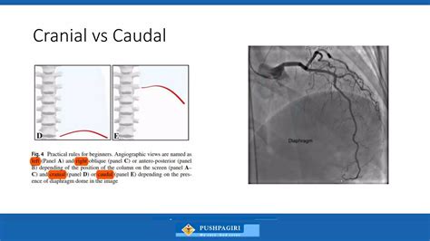 Coronary Angiography - Views - Dr Hafeesh Fazulu - PIMS.pptx