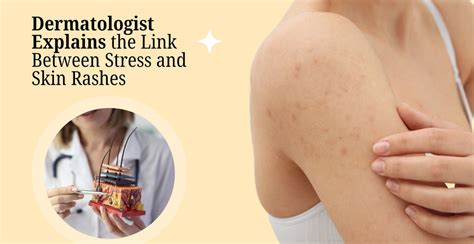 Stress and Skin Rashes Are They Related? | Clinikally