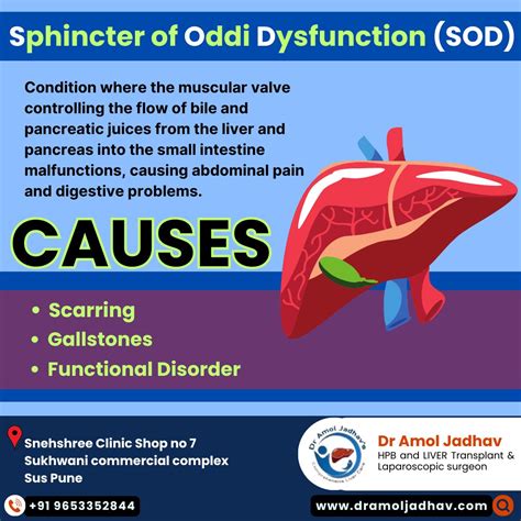 What is Sphincter of Oddi Dysfunction? | Dr Amol Jadhav's Comprehensive Liver Care posted on the ...
