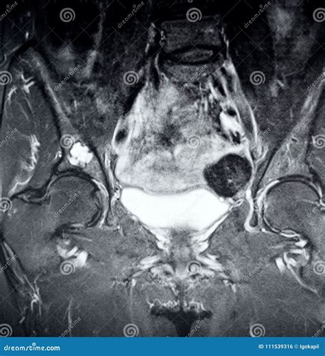Right Hip Osteoarthritis Pathology Mri Exam Stock Photo - Image of body ...