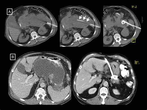 Radiology of acute pancreatitis today: The Atlanta classification and the current role of ...