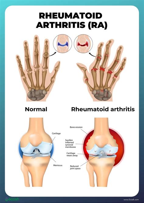 Arthritis Symptoms Teeth at Brian Phelps blog