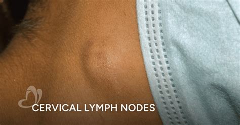 Swollen Cervical Lymph Nodes in Neck: Does It Mean Cervical Cancer ...