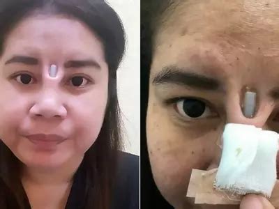 That's An Implant Sticking Out Of Her Nose! This Is The Harrowing Tale ...