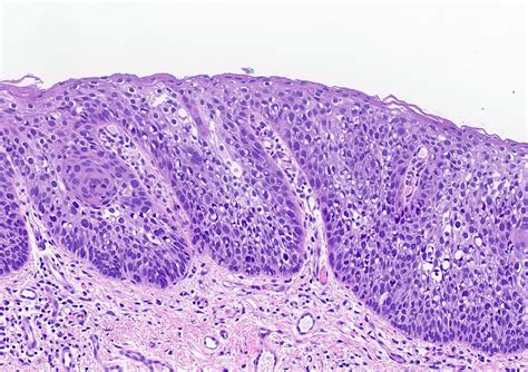 Pathology Outlines - Squamous dysplasia