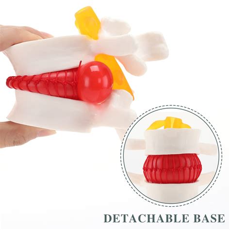 RONTEN Human Anatomical Lumbar Disc Herniation Model - India | Ubuy