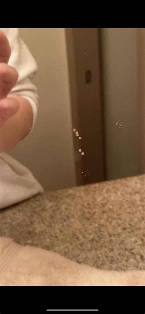 Image result for Extreme Zit Exploding