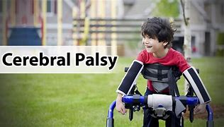 Image result for palsy