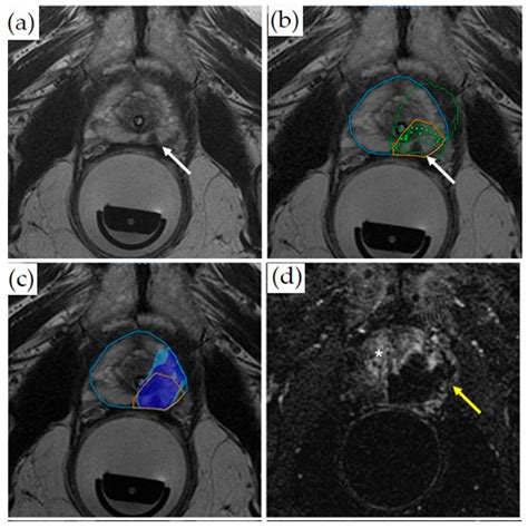 Real-Time MRI-Guided Prostate Interventions