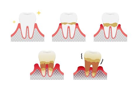 牙周炎龈下刮治的3D原理示意图