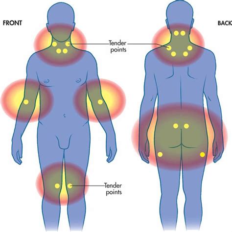 fibromyalgia 18 tender points