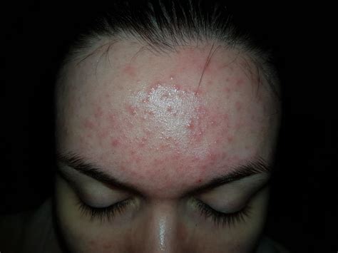 Red Bumps On Forhead | Renew Physical Therapy