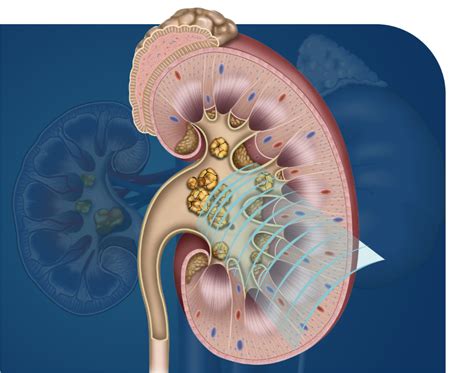 Lithotripsy Procedure 的图像结果