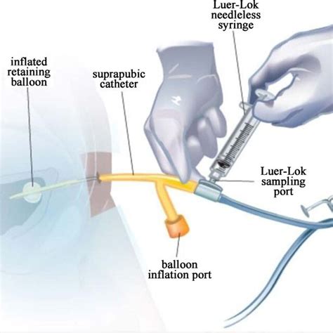 Image result for Urine Collection Method