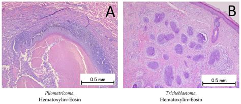 Pathophysiology, Histopathology, and Differential Diagnostics of Basal ...