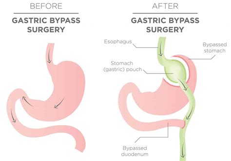 Consent: Gastric Bypass - TeachMeSurgery