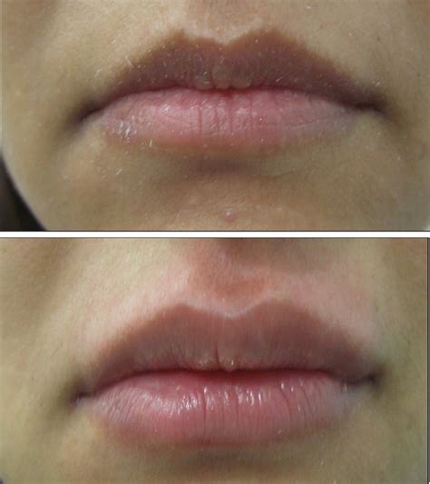 Lip Injections - Lip Augmentation, Types Of Lip Dermal Fillers, Safety