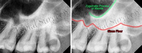 Caldwell-Luc Surgery