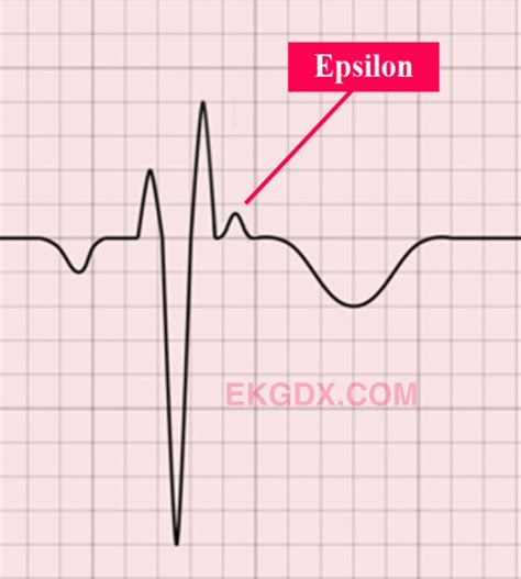 EKGDX - La nueva era del aprendizaje de EKG