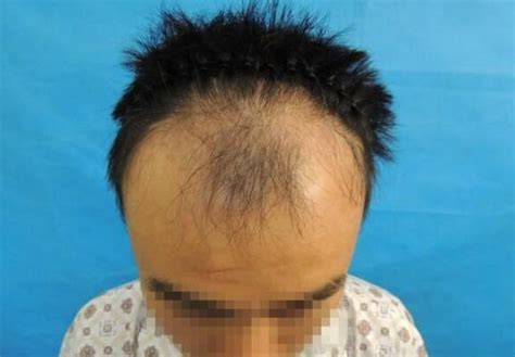 脱发、秃顶、M型脱发、遗传性脱发...如何拯救！|微信|脱发|遗传性_新浪新闻