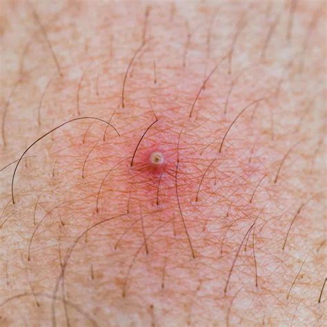 Threading Ingrown Hair at Stephanie Wolfe blog