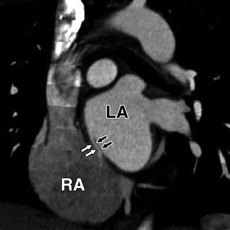 PFO Defect 的图像结果