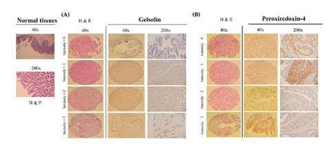 Cancers | Special Issue : Biomarker in Metastatic Colorectal Cancer