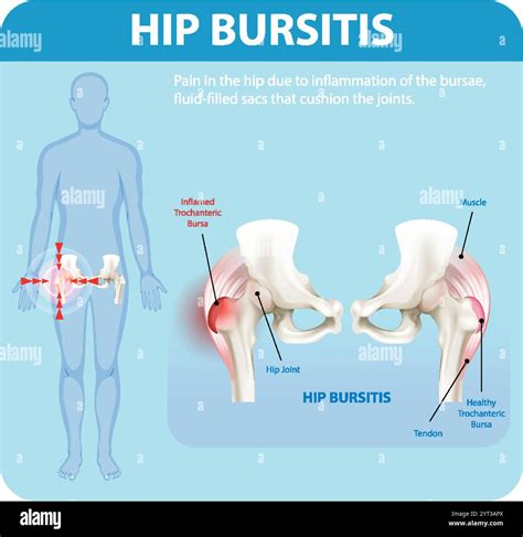 Ibuprofen For Hip Bursitis