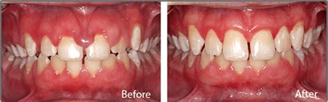 Gum Disease Treatment Tirupati | Stop Bleeding Gums