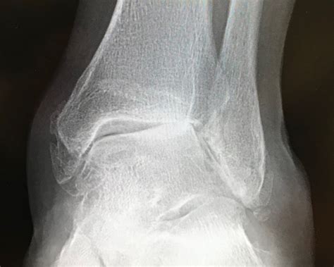 Ankle Fusion Surgery | Ankle Arthrodesis | David Redfern Surgery