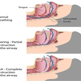 Image result for Obstructive Sleep Apnea