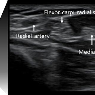 Image result for Transverse Line