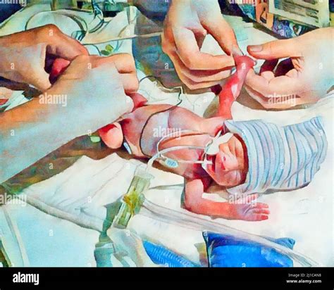 Image result for Neonatal Intubation Procedure
