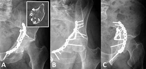 Geriatrische Acetabulum- und Beckenfrakturen: Behandlungsalgorithmen ...