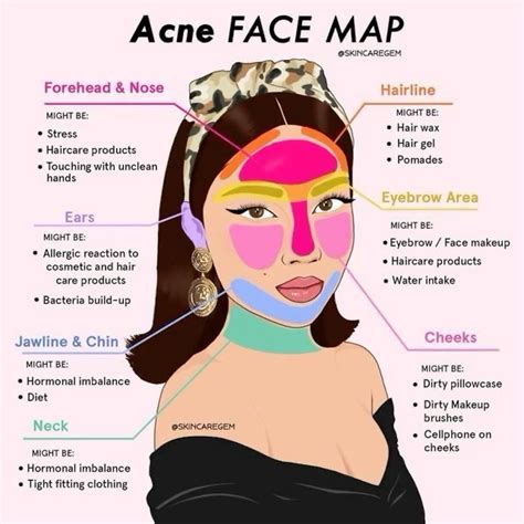 Best 13 Acne 101 l What Is Acne Telling You? Face Mapping Your Acne – Artofit