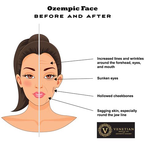 Ozempic Face Treatments: Reversing the Effects of Volume Loss