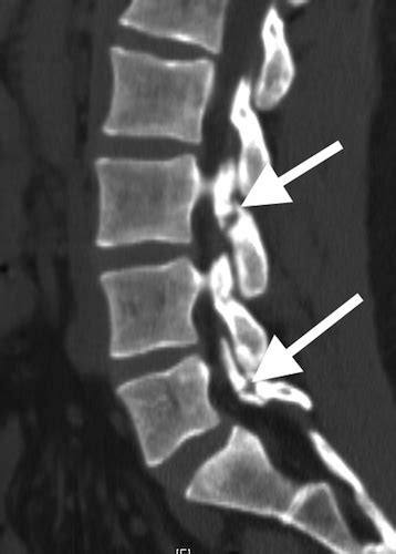 Kuvatulokset haulle pars fracture treatment