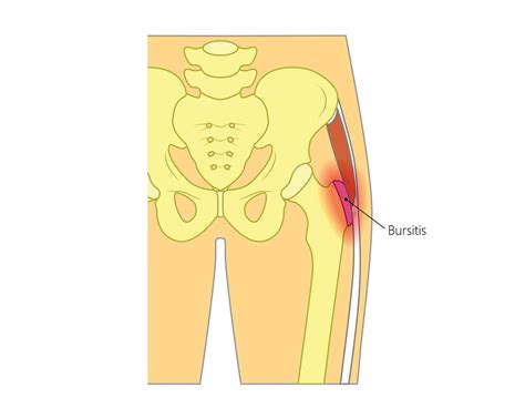 Sensational Info About How To Diagnose Hip Bursitis - Tonepop