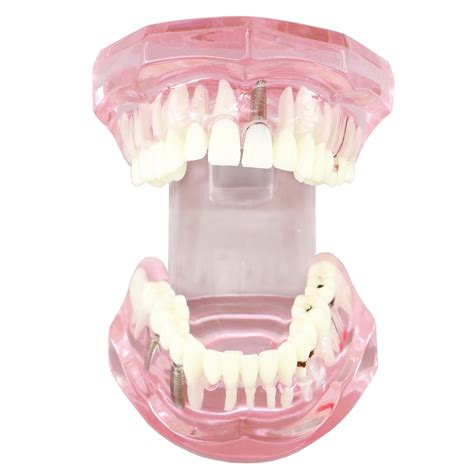 Dental Implant Teeth Model Bridge Restoration | Ubuy India
