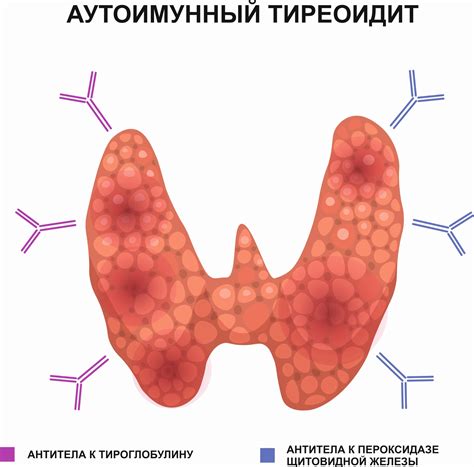 Аутоиммунный тиреоидит щитовидной железы: симптомы, лечение ...
