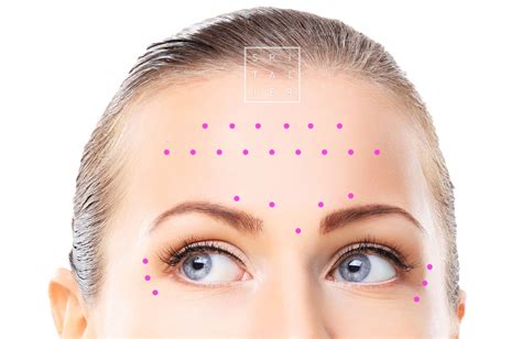 Image result for Botox Forehead Injection Sites Tutorial
