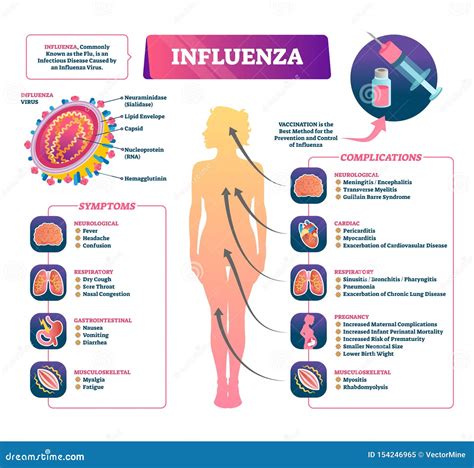 Influenza Vector Illustration. Labeled Flu Symptoms and Complication ...