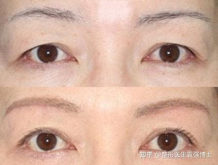 提眉手术前术后对比图片，提眉手术和提眉手术的不同之处~_千颜网