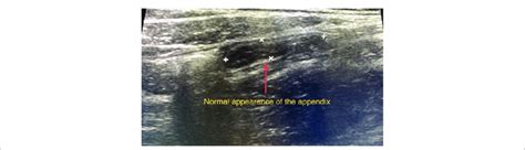 Image result for Normal Appendix Appearance