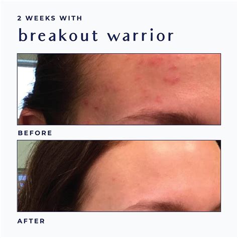 Salicylic Acid Acne Treatment Cream for Oily Skin - Hormonal & Cystic Acne Relief - 90-Day ...