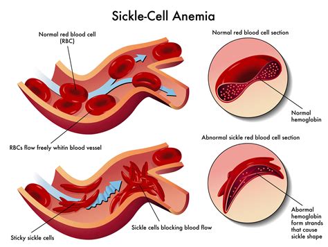 New treatment for sickle cell anemia | WorldwithTJ
