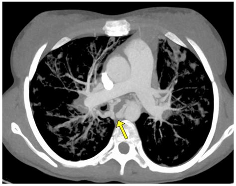 Role of Bronchial Artery Embolization as Early Treatment Option in ...