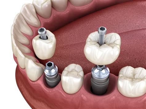 The Three Major Parts Of Your Dental Implant | Livonia, MI